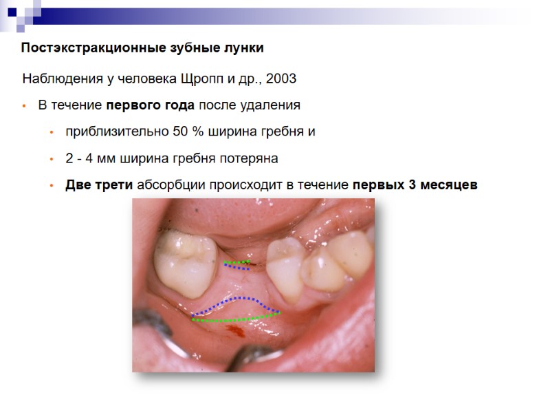 Постэкстракционные зубные лунки Коллаген Наблюдения у человека Щропп и др., 2003 В течение первого